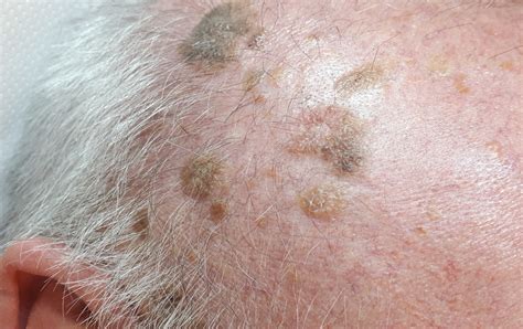 Seborrheic Keratosis (Senile Warts) Removal - Altrincham, Manchester