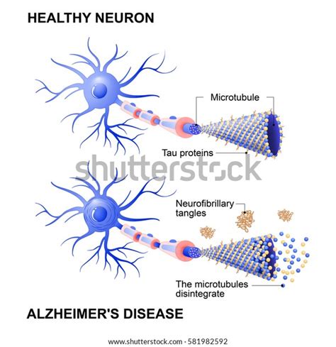 65 Neurofibrillary Tangles Images, Stock Photos & Vectors | Shutterstock