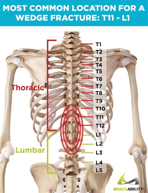 L1 Vertebral Compression Fracture