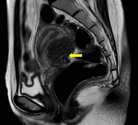 Ovarian endometrioma: diagnostic mimickers in MRI | Eurorad