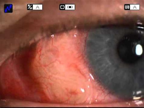 Solitary Subconjunctival Moving Parasite- Dirofilaria repens. - YouTube