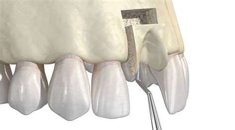 Distraction Osteogenesis - Foley & Le Oral Surgery | Oral Surgery Boulder CO