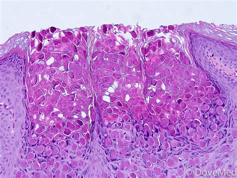 Molluscum Contagiosum