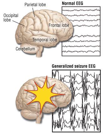 Absence Seizures (Petit Mal Seizures) Guide: Causes, Symptoms and Treatment Options