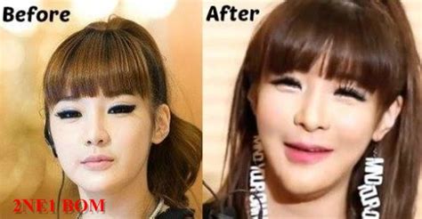 2ne1 Park BOM plastic surgery before and after photos, Pictures - 2016 Plastic Surgery before ...