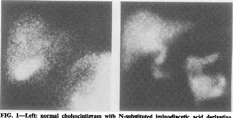 Figure 1 from Nonvisualization of the gallbladder by 99mTc-HIDA cholescintigraphy as evidence of ...