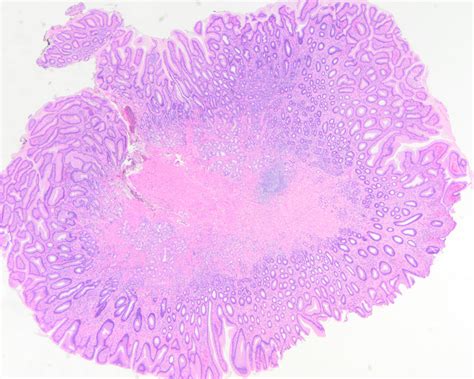 Hyperplastic Polyp Colon