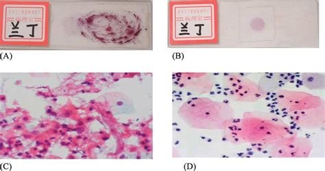 Comparison of conventional Pap smear to liquid-based preparation. (A ...