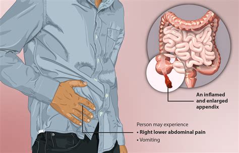 Demystifying Appendicitis: Exploring Symptoms, Causes, Diagnosis, Treatment, and Complications ...