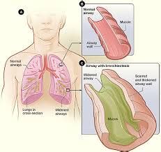 Best Benign Lung Tumor Treatment in Delhi | Chest Surgery Delhi