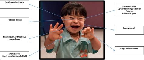 Down Syndrome - TeachMePaediatrics