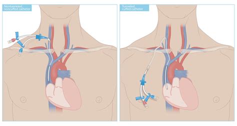 Tunneled Central Line (Tunneled Central Venous Catheter), 46% OFF