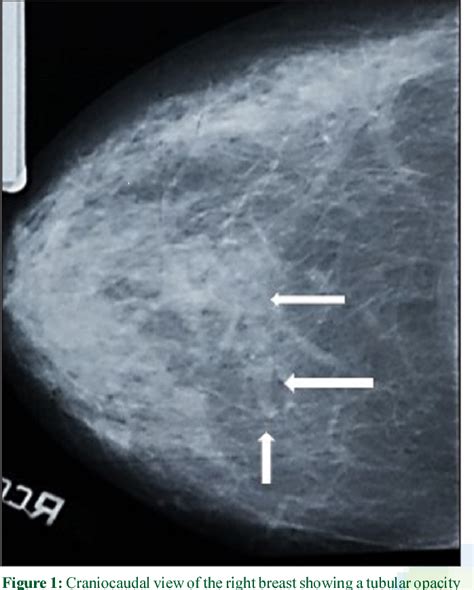 Figure 1 from Mondor's disease of the breast in a Nigerian woman ...