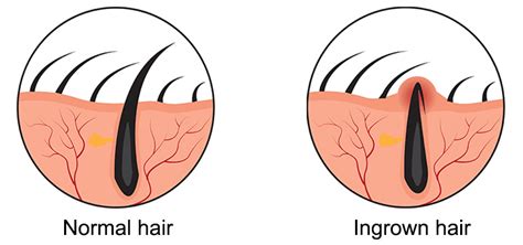 How to Treat Ingrown Hairs? | What Causes Ingrown Hair? | What is an ...