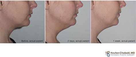 Recovery after Kybella treatment of neck fat – Potomac Plastic Surgery