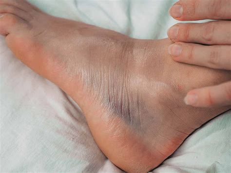 Os Trigonum Syndrome: Bozeman MT | Bozeman Foot and Ankle Clinic