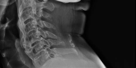 Diffuse Idiopathic Skeletal Hyperostosis (DISH) Causes, Symptoms, Diagnosis and Treatment ...