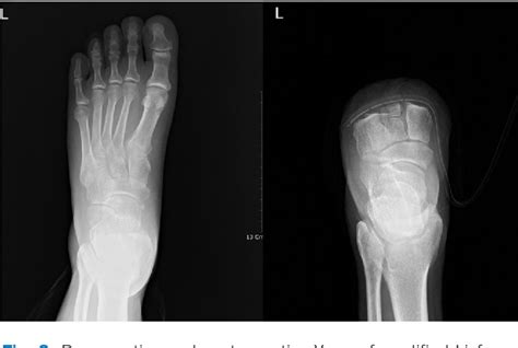 Figure 3 from Modified Lisfranc Amputation to Reduce Hematoma Rate in ...