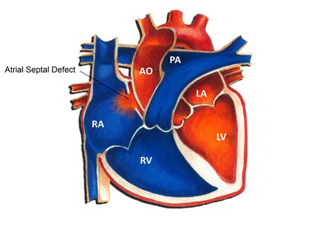 Atrial Septal Defect - Pediatric Heart Specialists