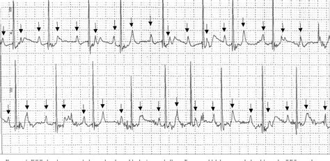 Figure 1 from A Patient with Congenital Complete Heart Block Undergoing Multiple Exposures to ...