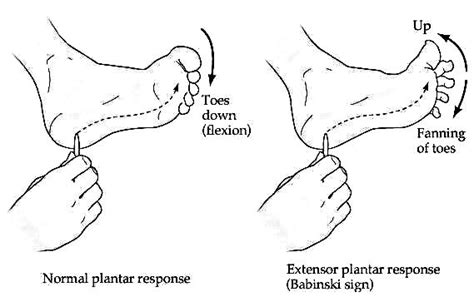 Plantar reflex - EduMedWeb