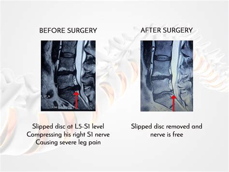 Endoscopic Spine Surgery, Slipped disc, Spinal fusion surgery, Mumbai