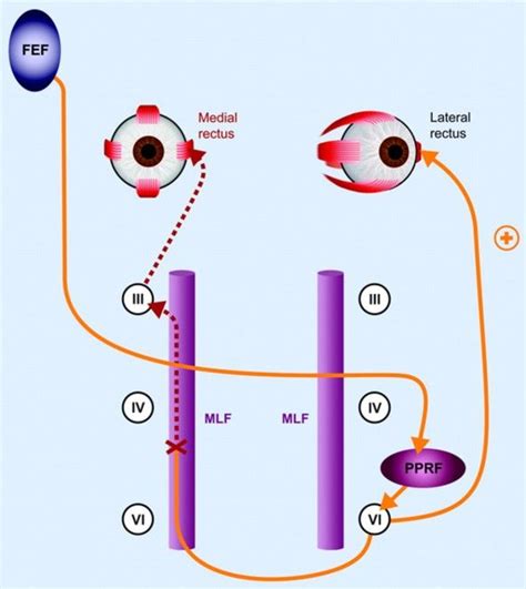 Internuclear ophthalmoplegia | Internuclear ophthalmoplegia, Medical education, Emergency medicine