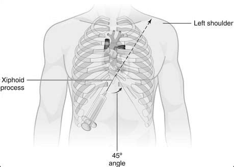 Pericardiocentesis • LITFL • CCC Procedure