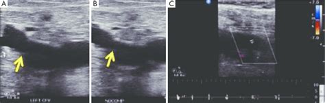 Acute deep vein thrombosis on ultrasound. Gray scale ultrasound... | Download Scientific Diagram