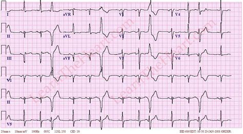 Các bất thường trên ECG: