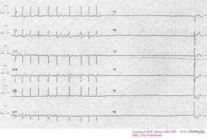 Sick Sinus Syndrome - ECGpedia