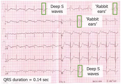 Bundle Branch and Fascicular Blocks | Concise Medical Knowledge