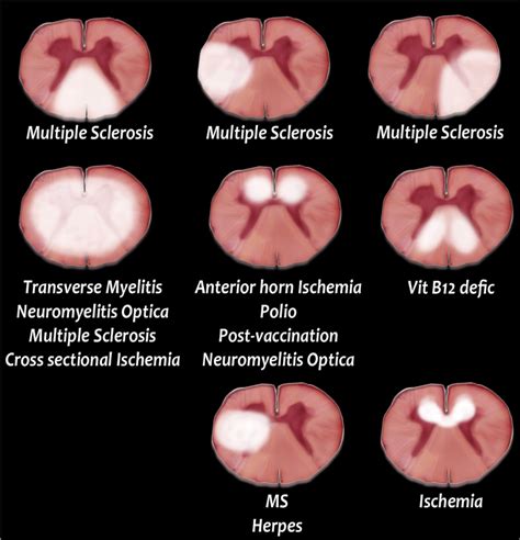 Spinal Cord Lesions | Radiology, Spinal cord lesions, Spinal lesion