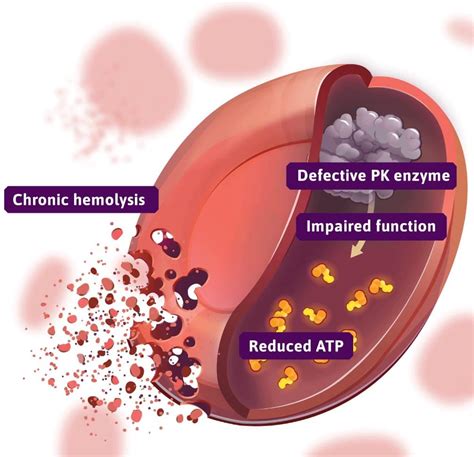 About Pyruvate Kinase (PK) Deficiency | PYRUKYND® (mitapivat) tablets