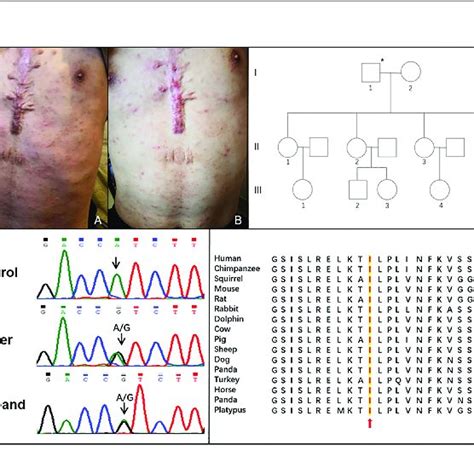 Patient 2, a 16-year-old boy with confirmed PAPA syndrome, at... | Download Scientific Diagram