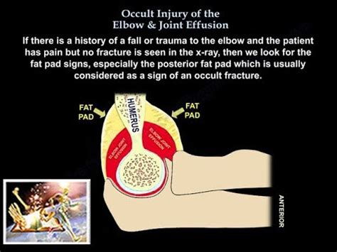 Joint Effusion Treatment