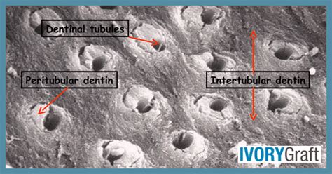 Dentin - Anatomy and Histology - Ivory Dentin Graft™