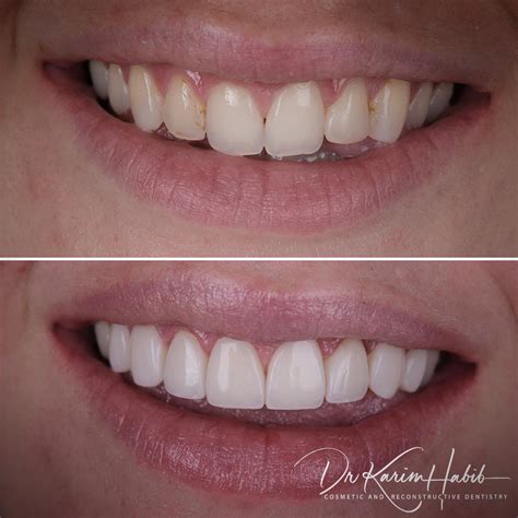 Composite Veneers Sydney | Dental Bonding Sydney - Dentist Ryde ...