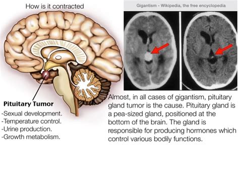 Pituitary Gland Tumor Gigantism