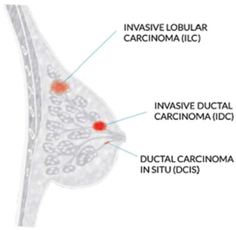 Invasive Ductal Carcinoma Diagram