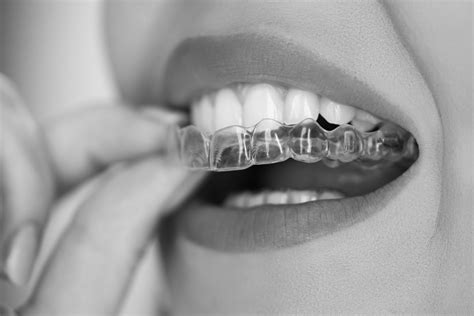 Is Invisalign Covered By Health Insurance In Australia?