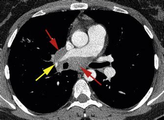 Mediastinum: Lymph Node Abnormalities and Masses | Radiology Key