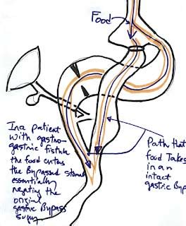 Gastro-gastric fistula after gastric bypass operation - DSSurgery