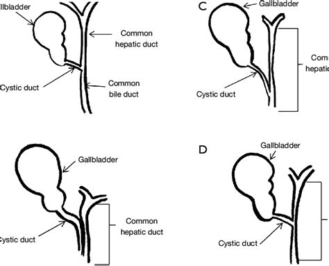 Cystic Duct Variant Anatomy