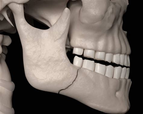 Maxilla and Mandible Fracture Treatments | Happy Dental and General Health Care