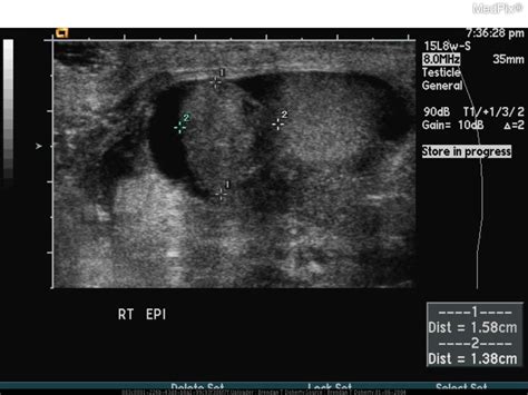 Epididymitis Ultrasound