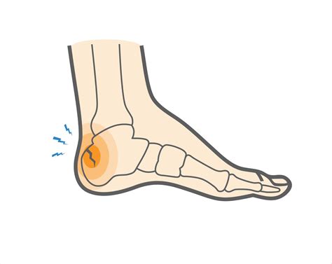 What is a Calcaneal Stress Fracture & How to Recover? - Upswing Health