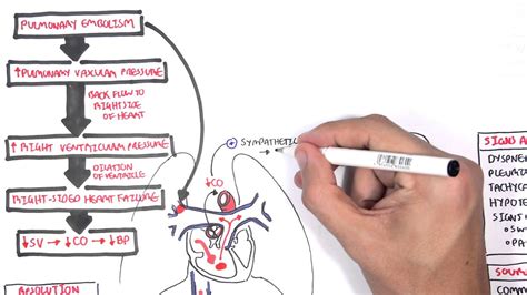 Pulmonary Embolism Types