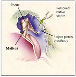 Ossiculoplasty: patient information - Sunnybrook Hospital