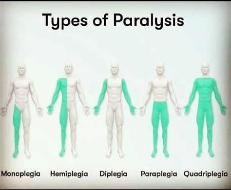 Types of Paralysis